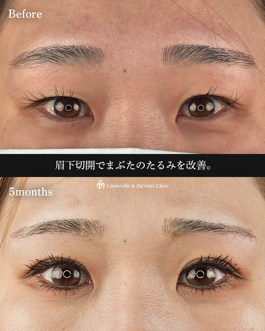 眉下切開でたるみ切除の画像