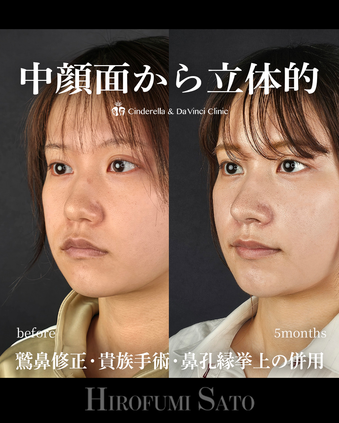 ナチュラルな忘れ鼻の画像