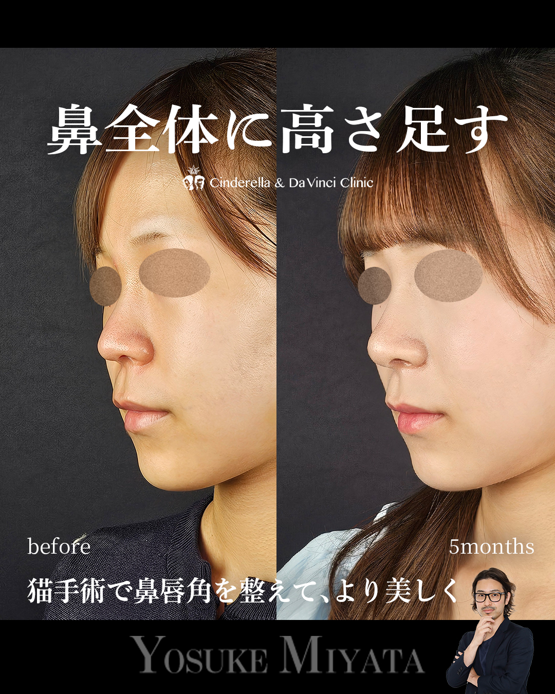 鼻全体の高さを出すの画像