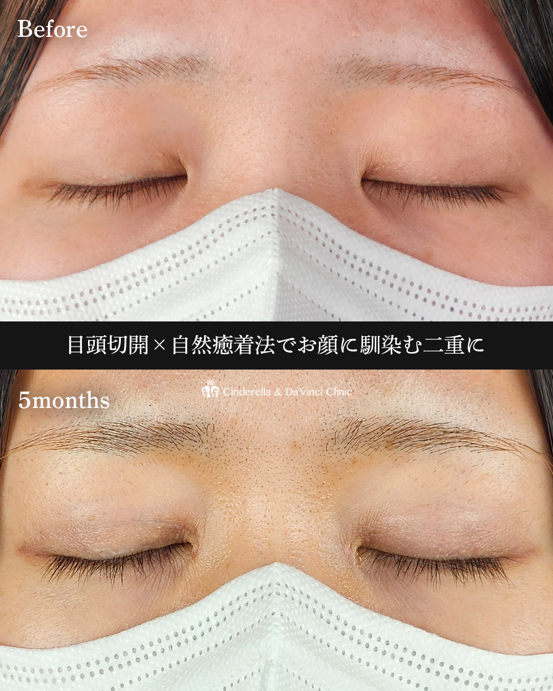 目頭切開と埋没の画像