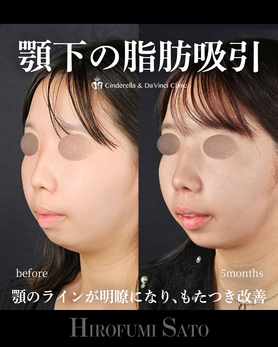 顎下の脂肪吸引の画像