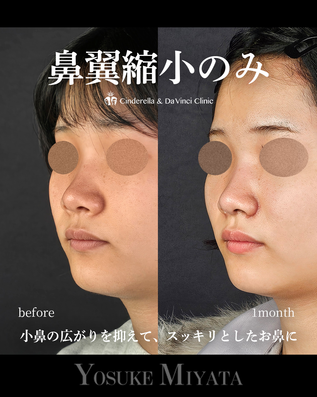 鼻翼縮小のみの画像