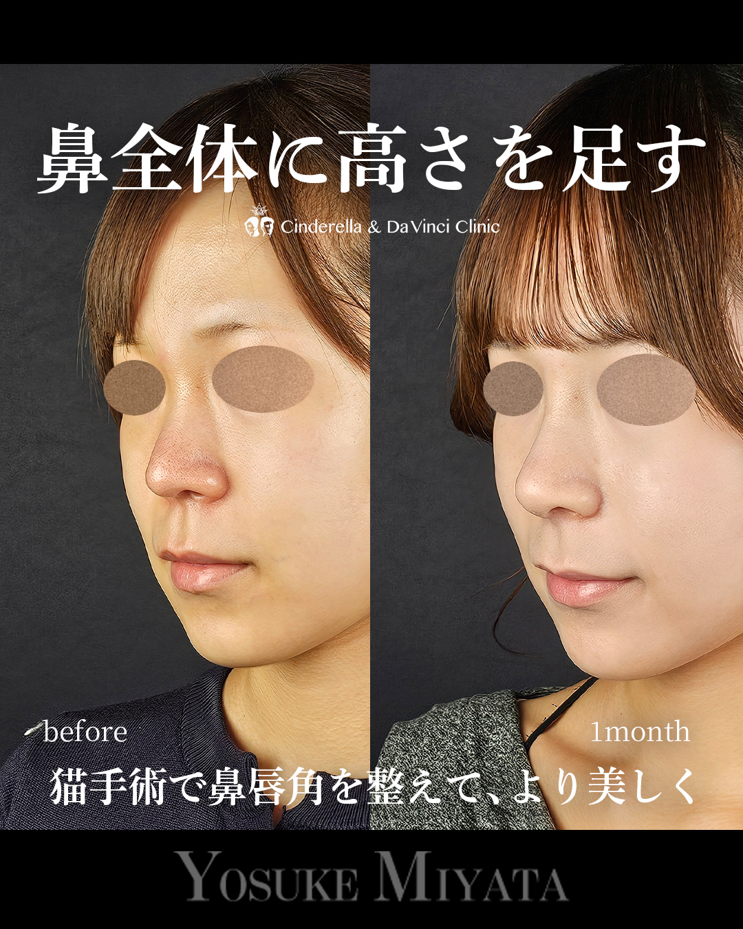 鼻全体の高さを出すの画像