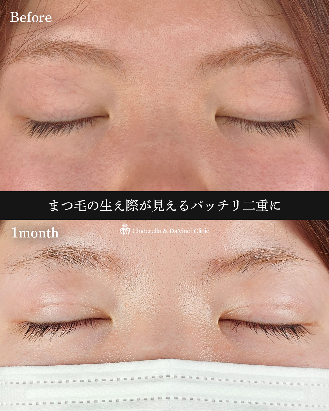 パッチリ二重の画像