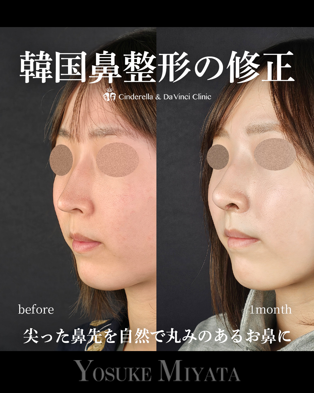 韓国鼻整形の修正の画像