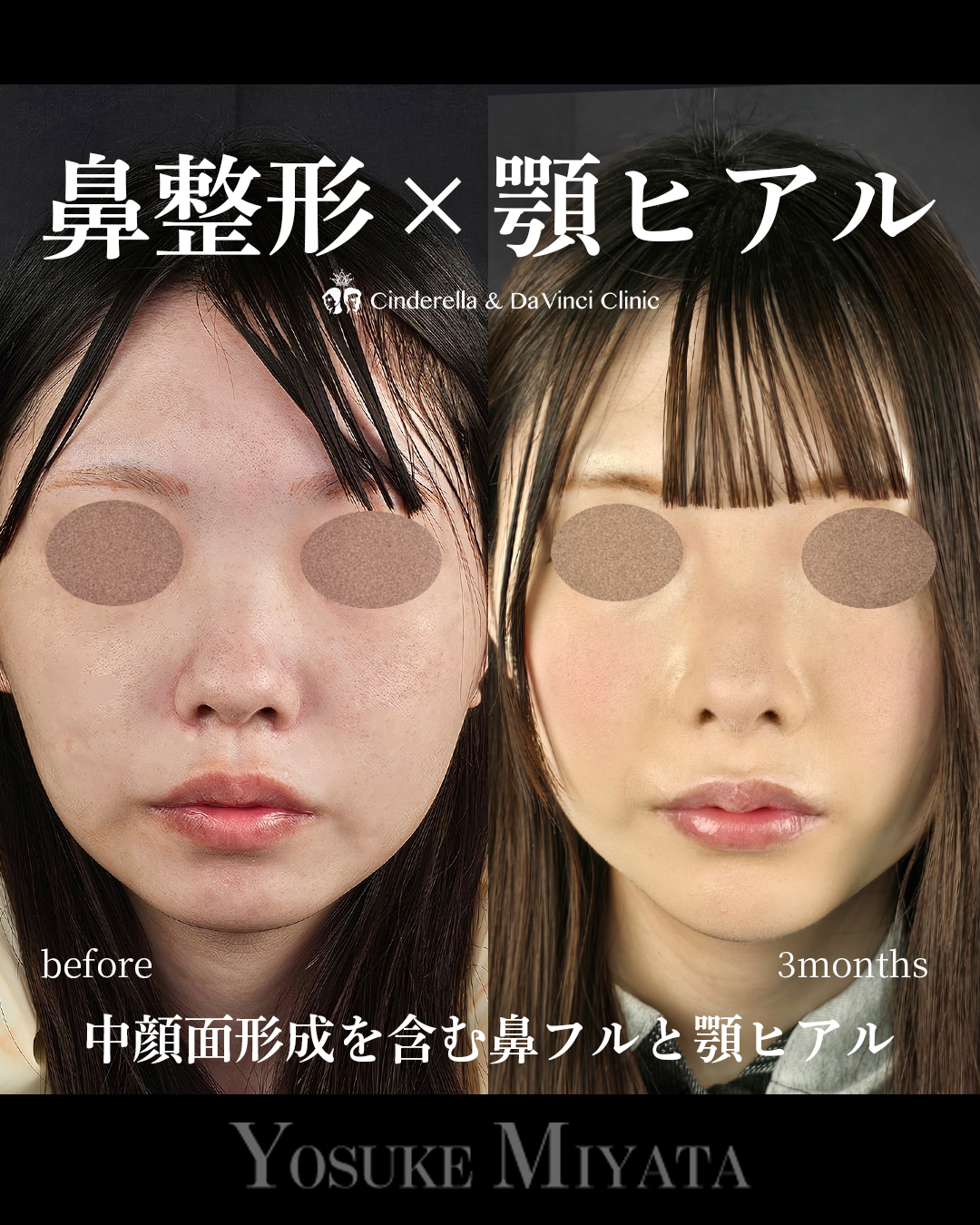 鼻整形と顎ヒアルの画像