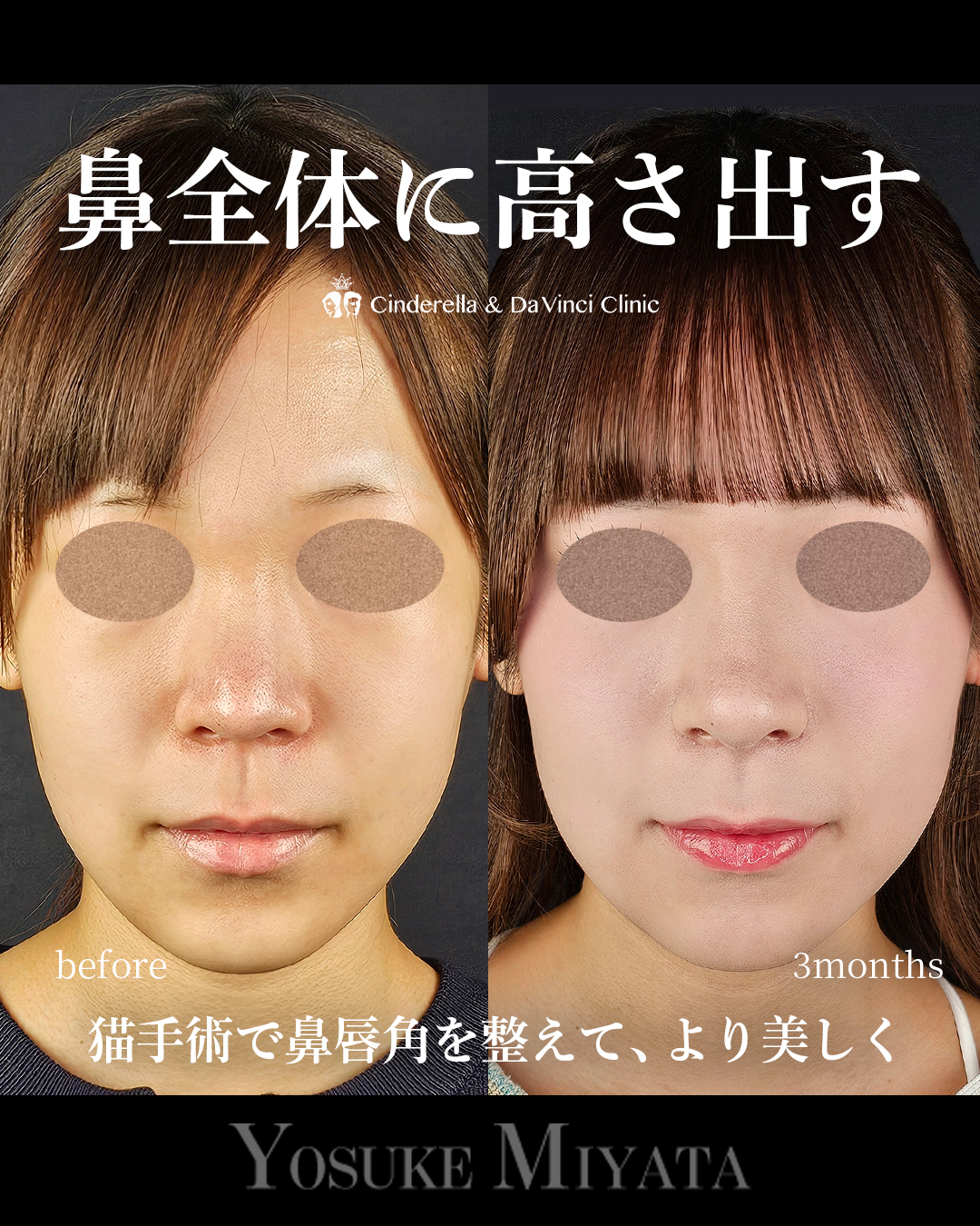 鼻全体の高さを出すの画像
