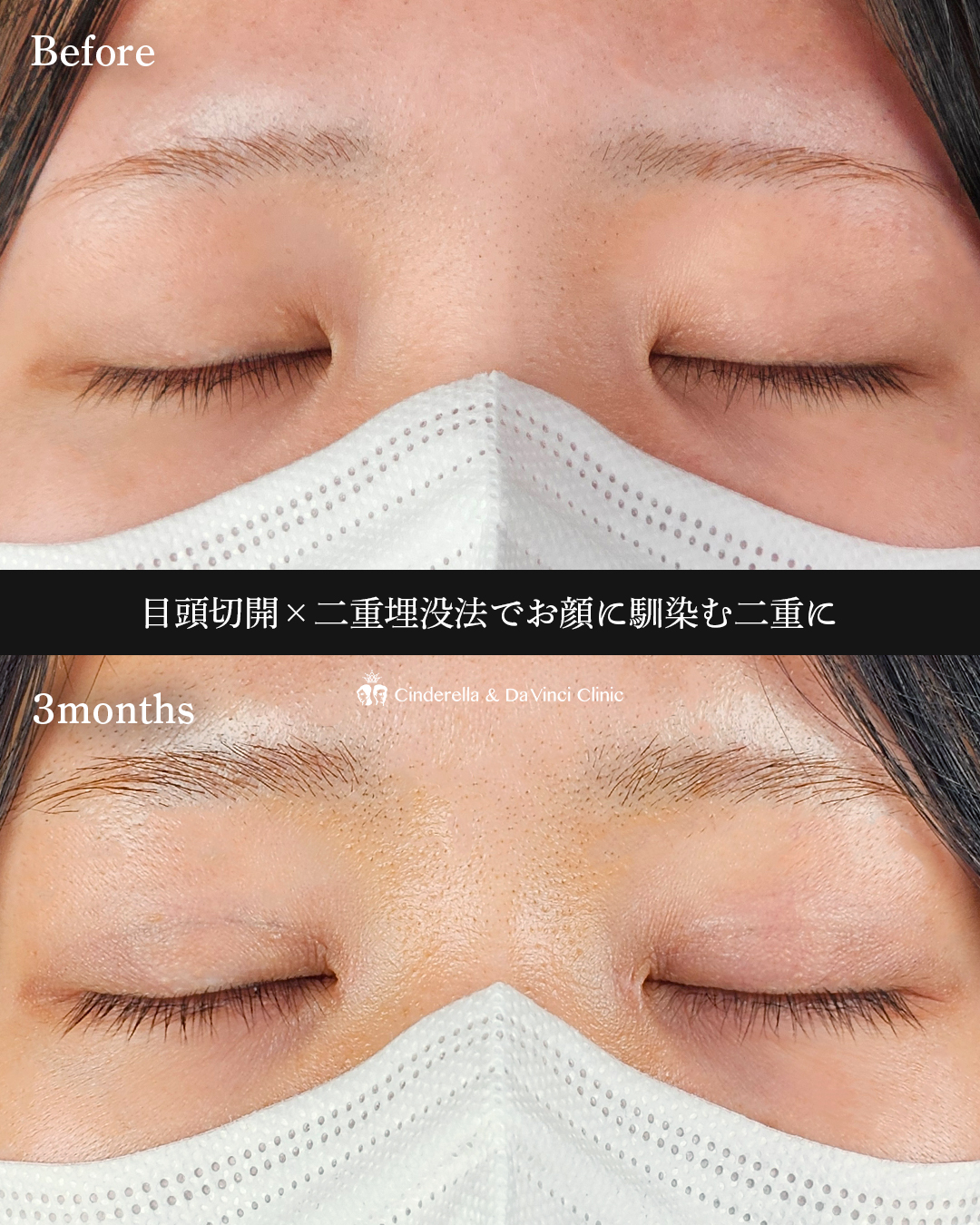 目頭切開と埋没の画像