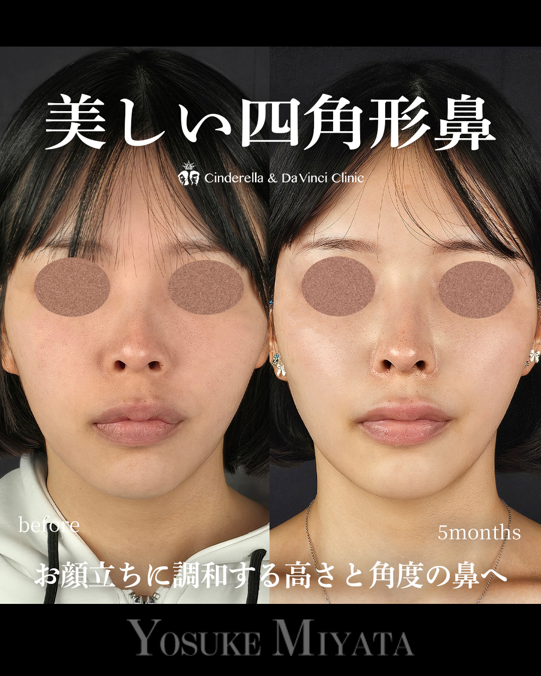 綺麗な四角形鼻の画像