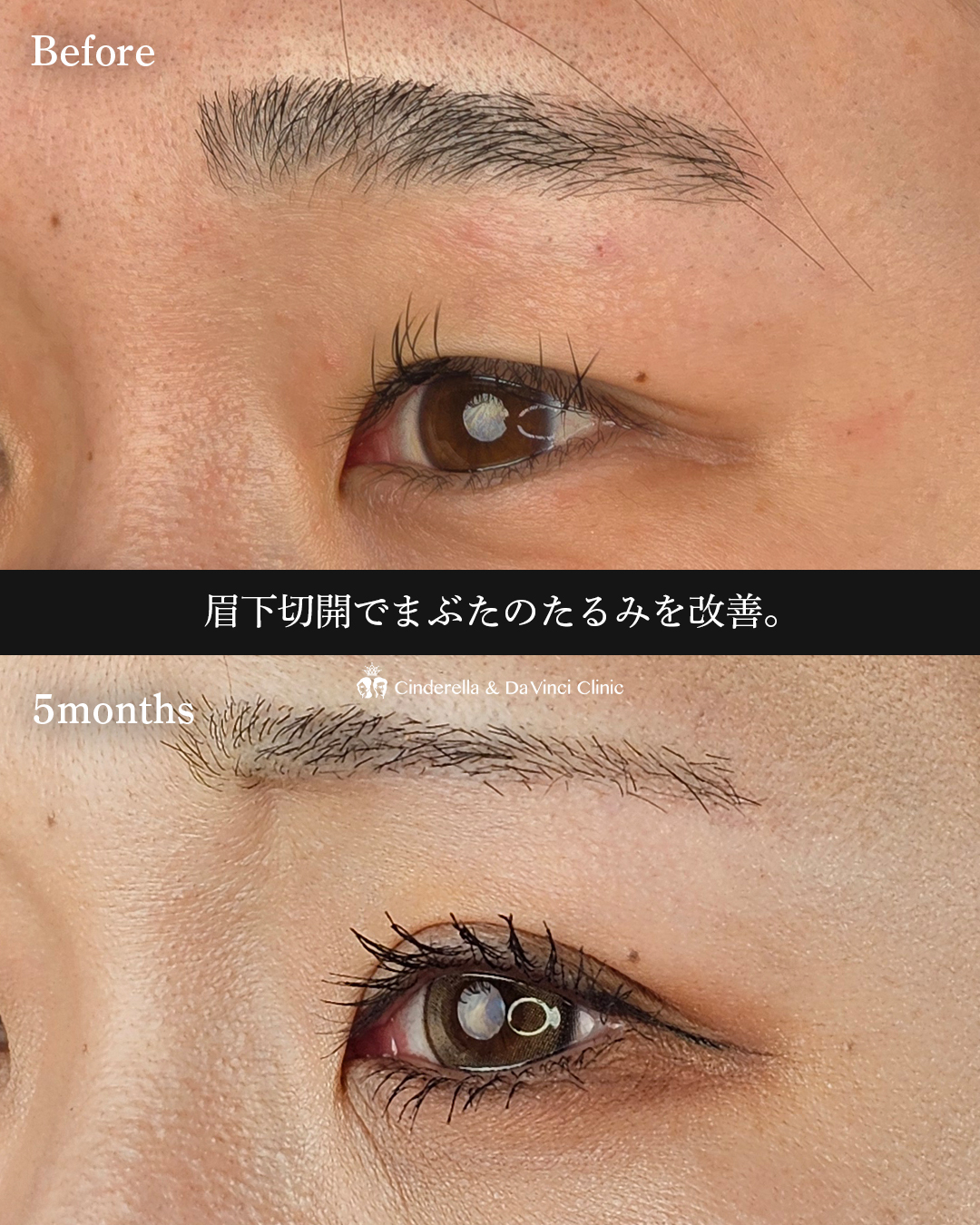 眉下切開でたるみ切除の画像