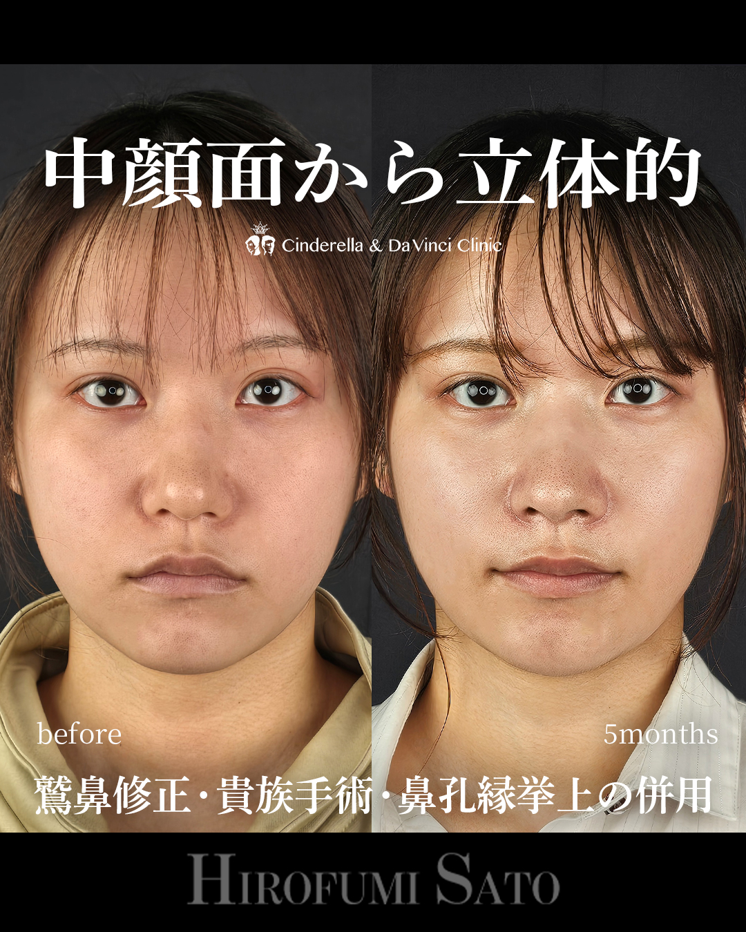 ナチュラルな忘れ鼻の画像