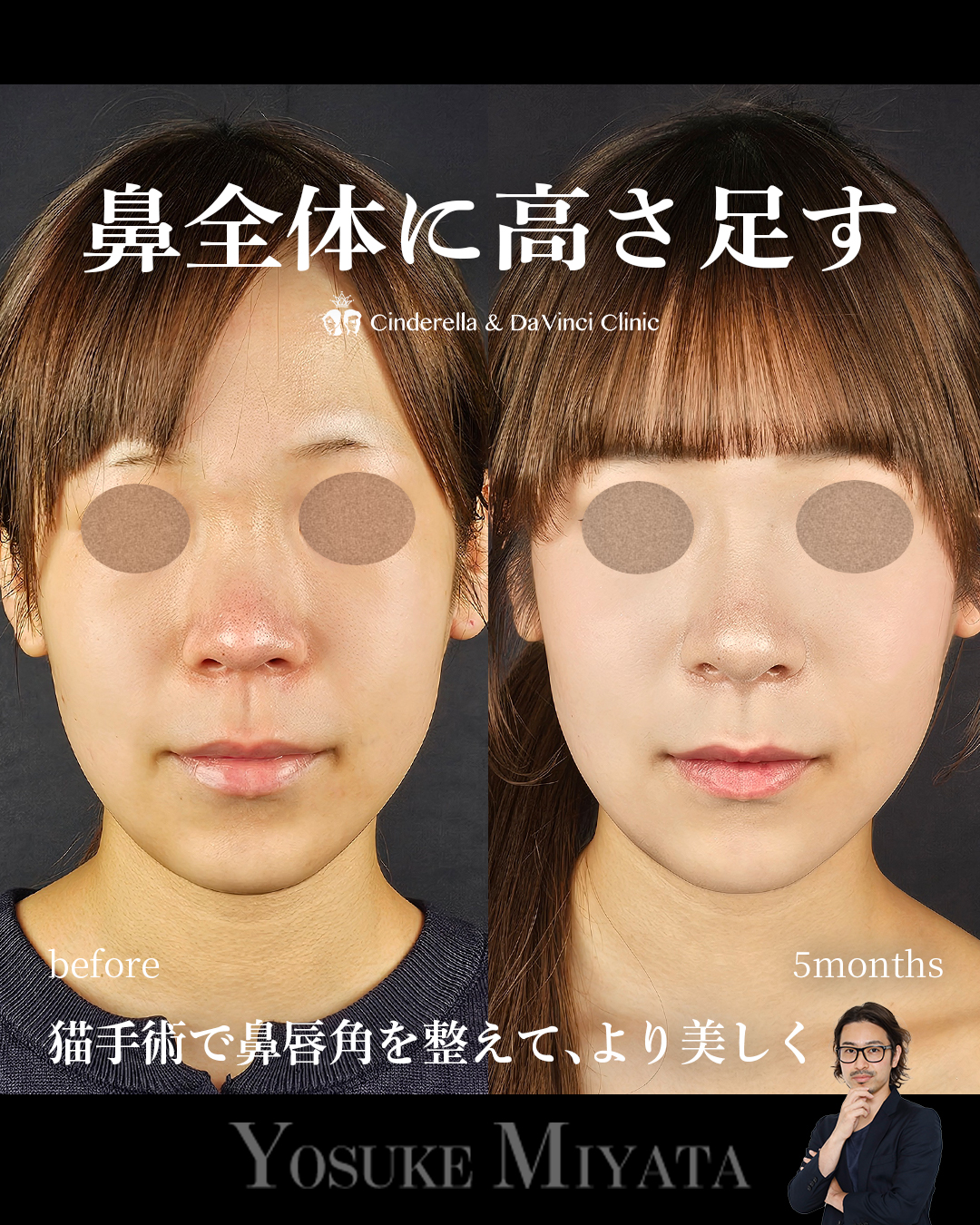 鼻全体の高さを出すの画像