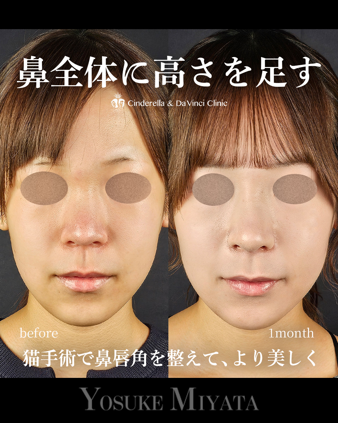 鼻全体の高さを出すの画像