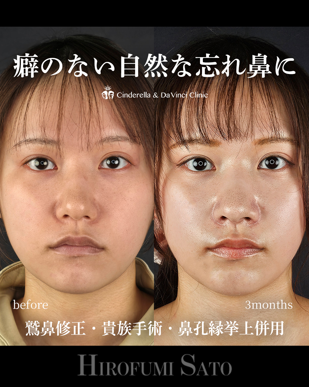ナチュラルな忘れ鼻の画像