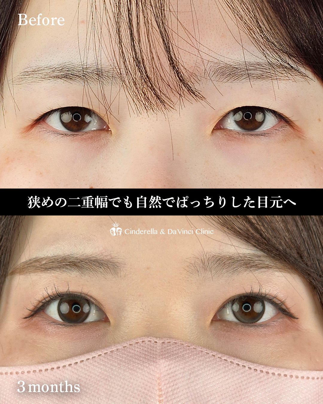切開でナチュラルな二重の画像