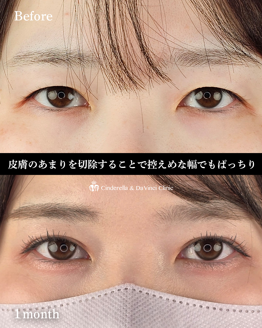 切開でナチュラルな二重の画像