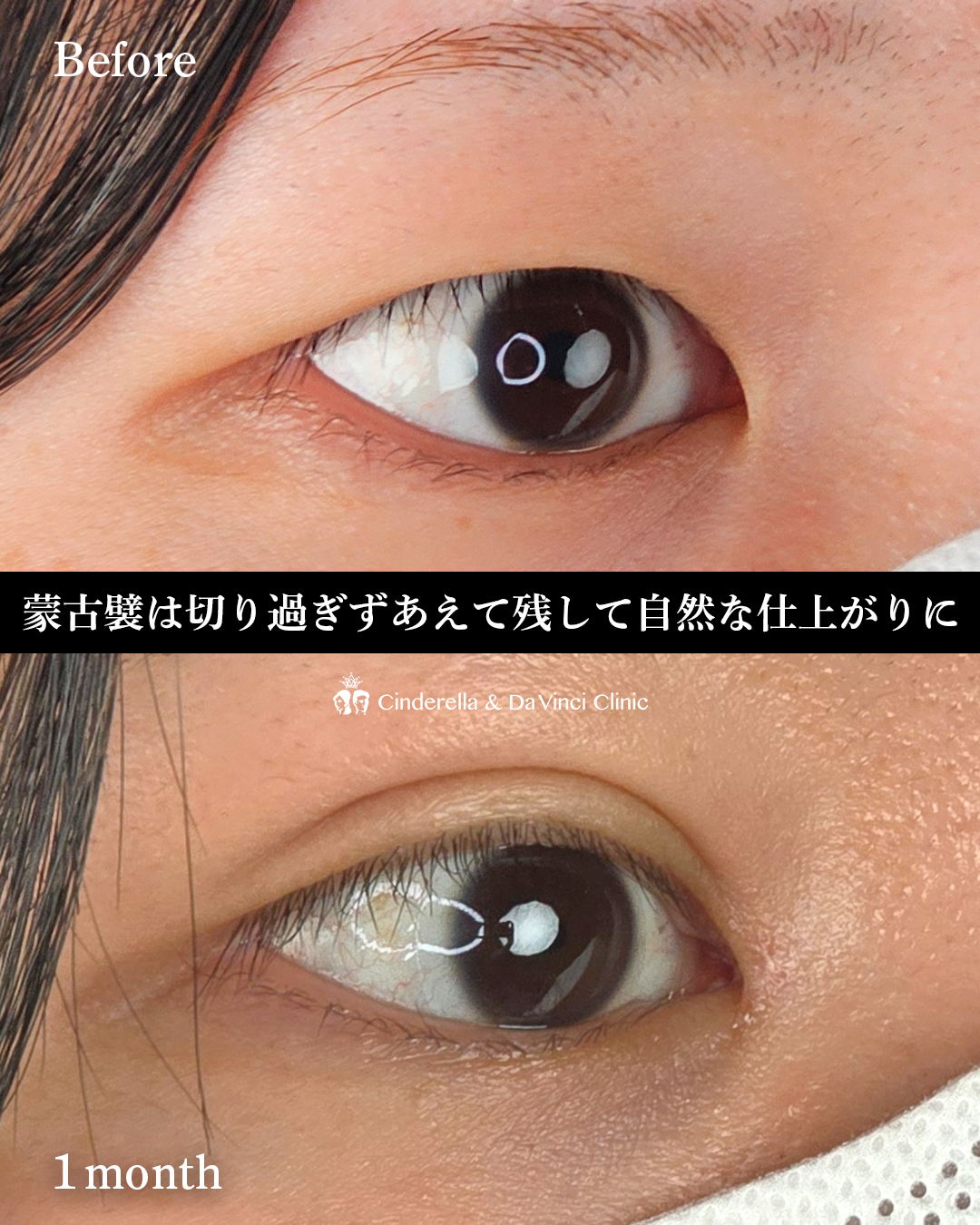 目頭切開と埋没の画像