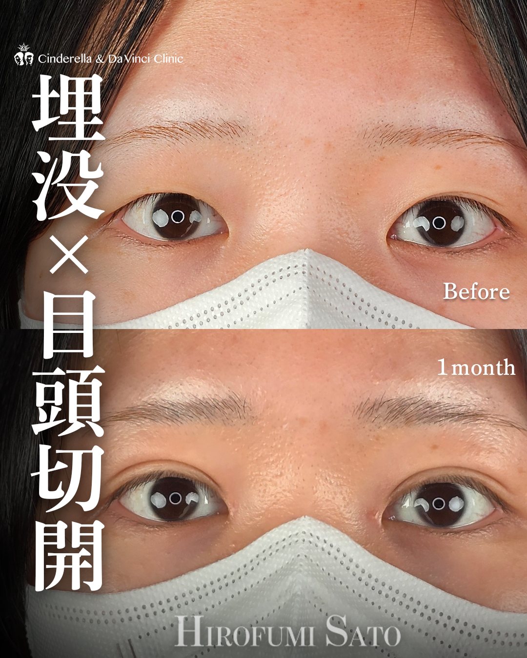 目頭切開と埋没