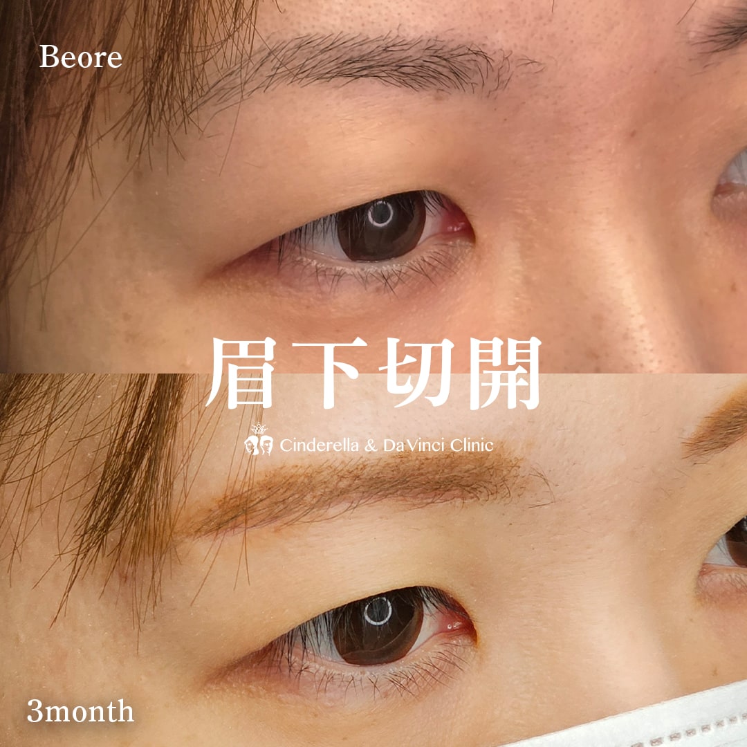 眉下切開