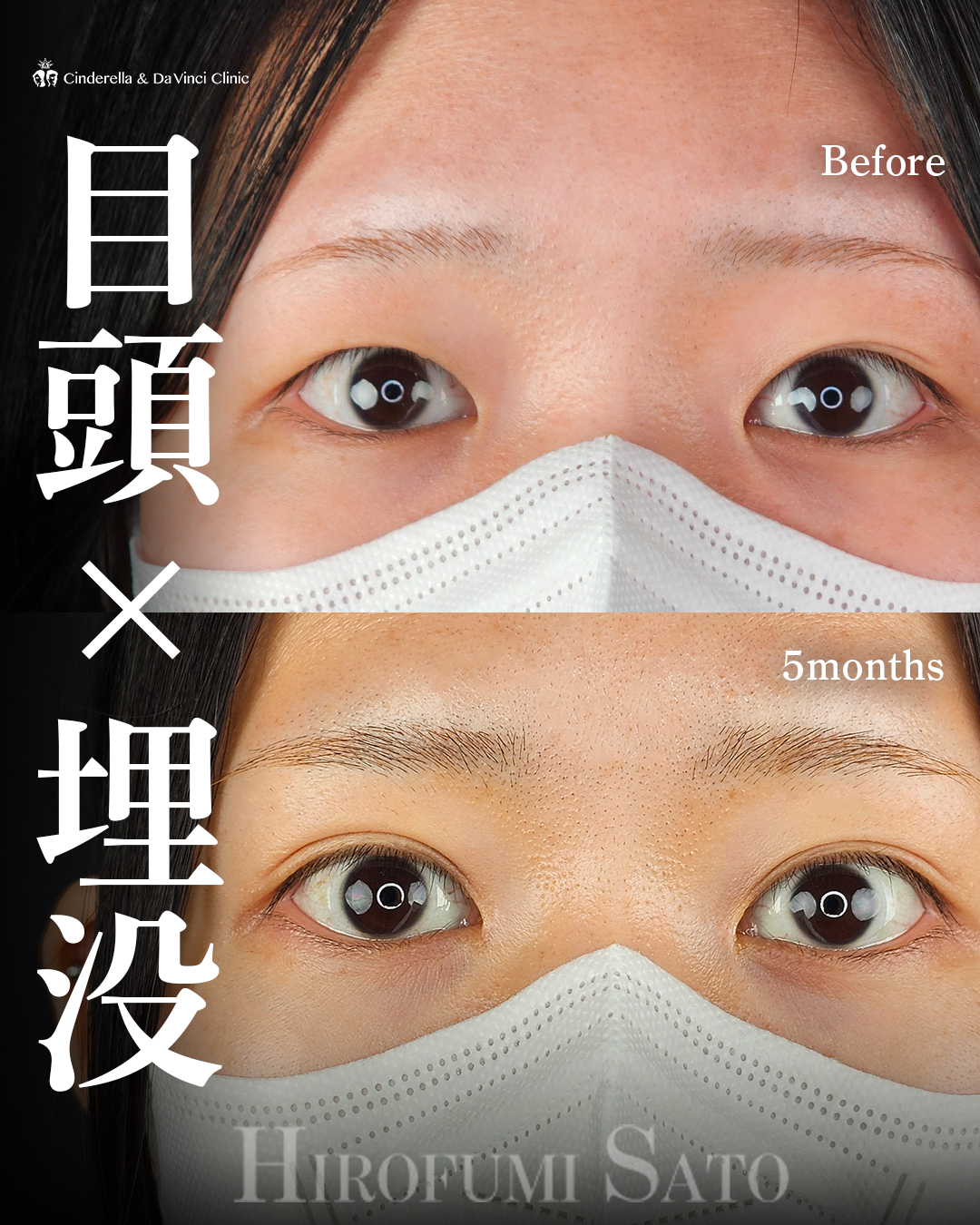 目頭切開と埋没の画像