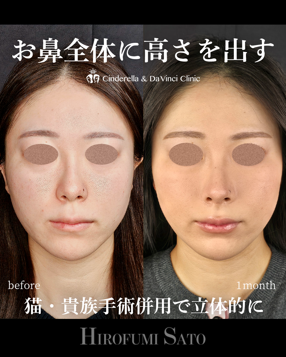 鼻を全体的に高く