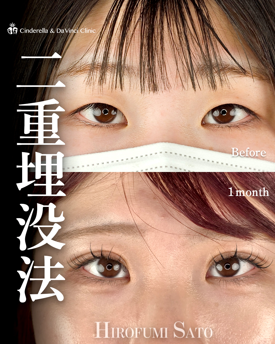 埋没で平行二重