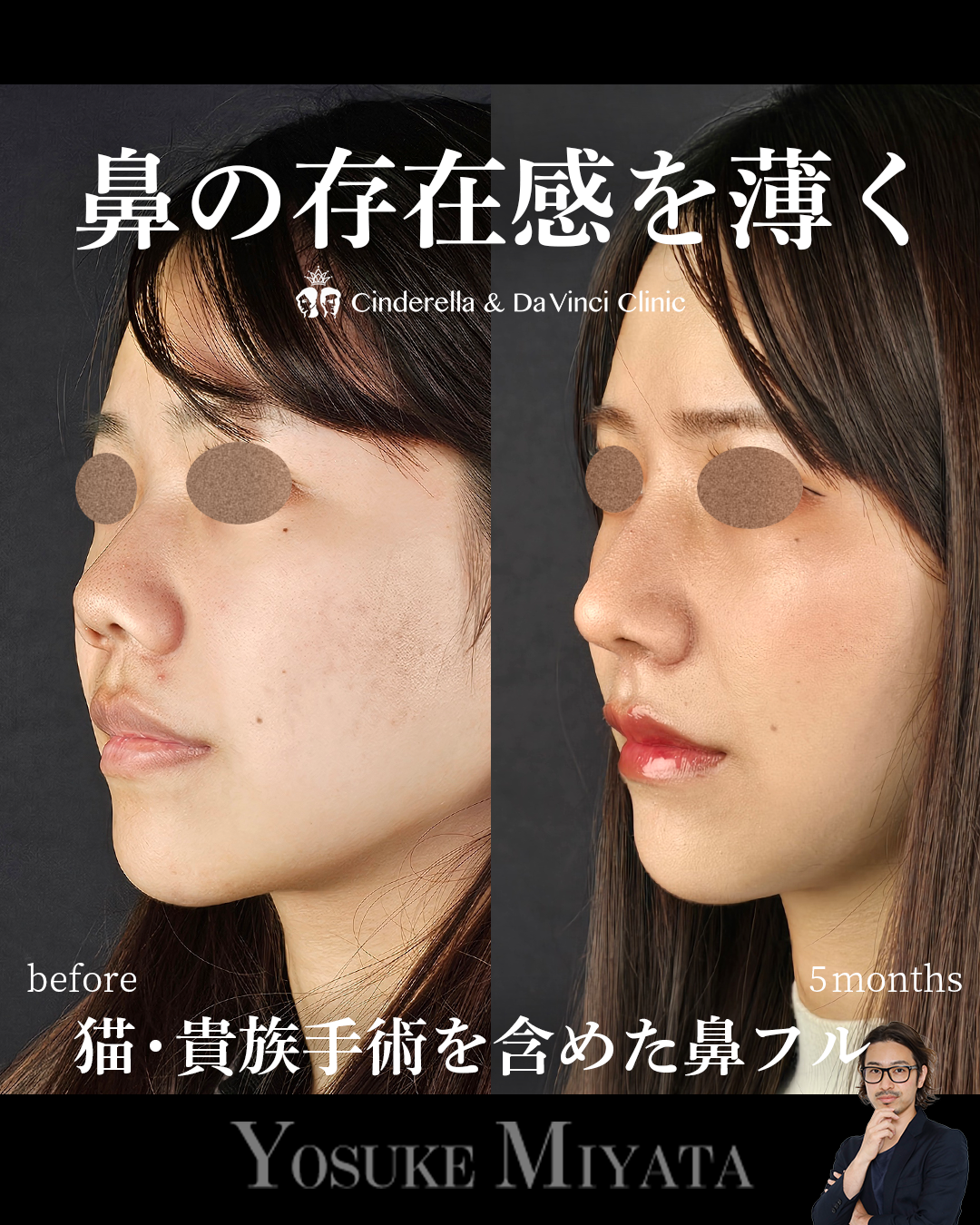 鼻の存在感を薄くの画像