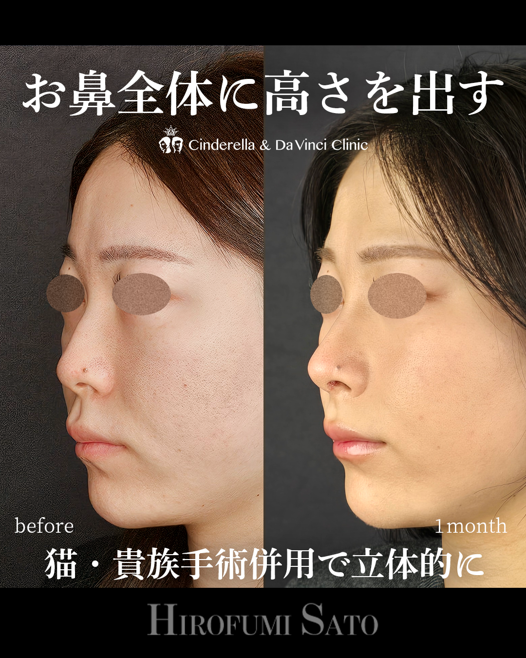 鼻を全体的に高くの画像