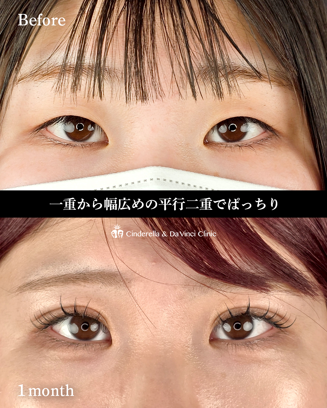 埋没で平行二重の画像