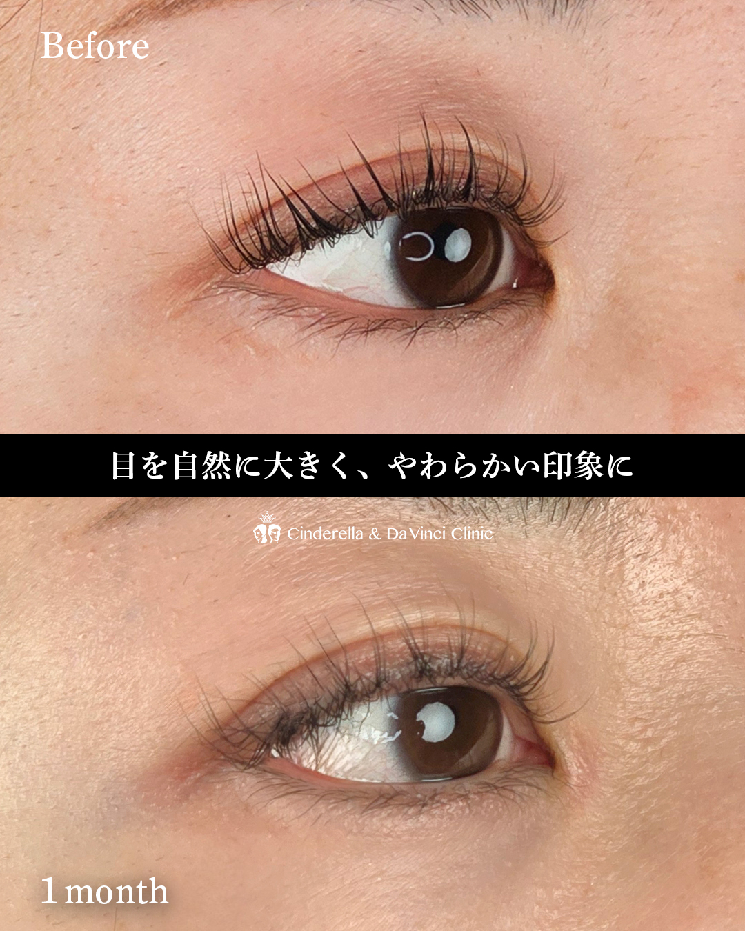 目頭切開とタレ目同時の画像