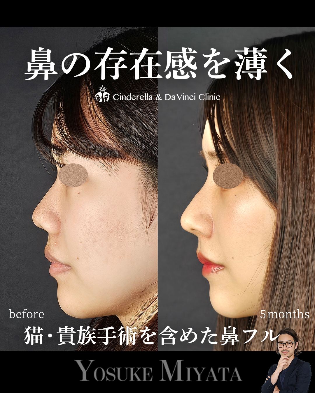 鼻の存在感を薄くの画像