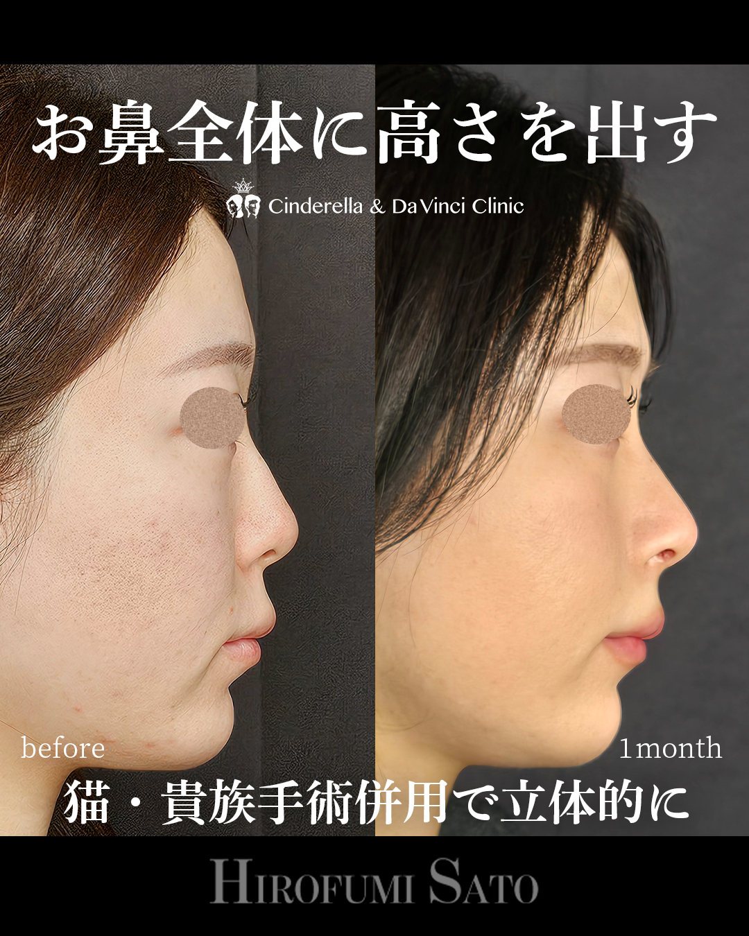 鼻を全体的に高くの画像