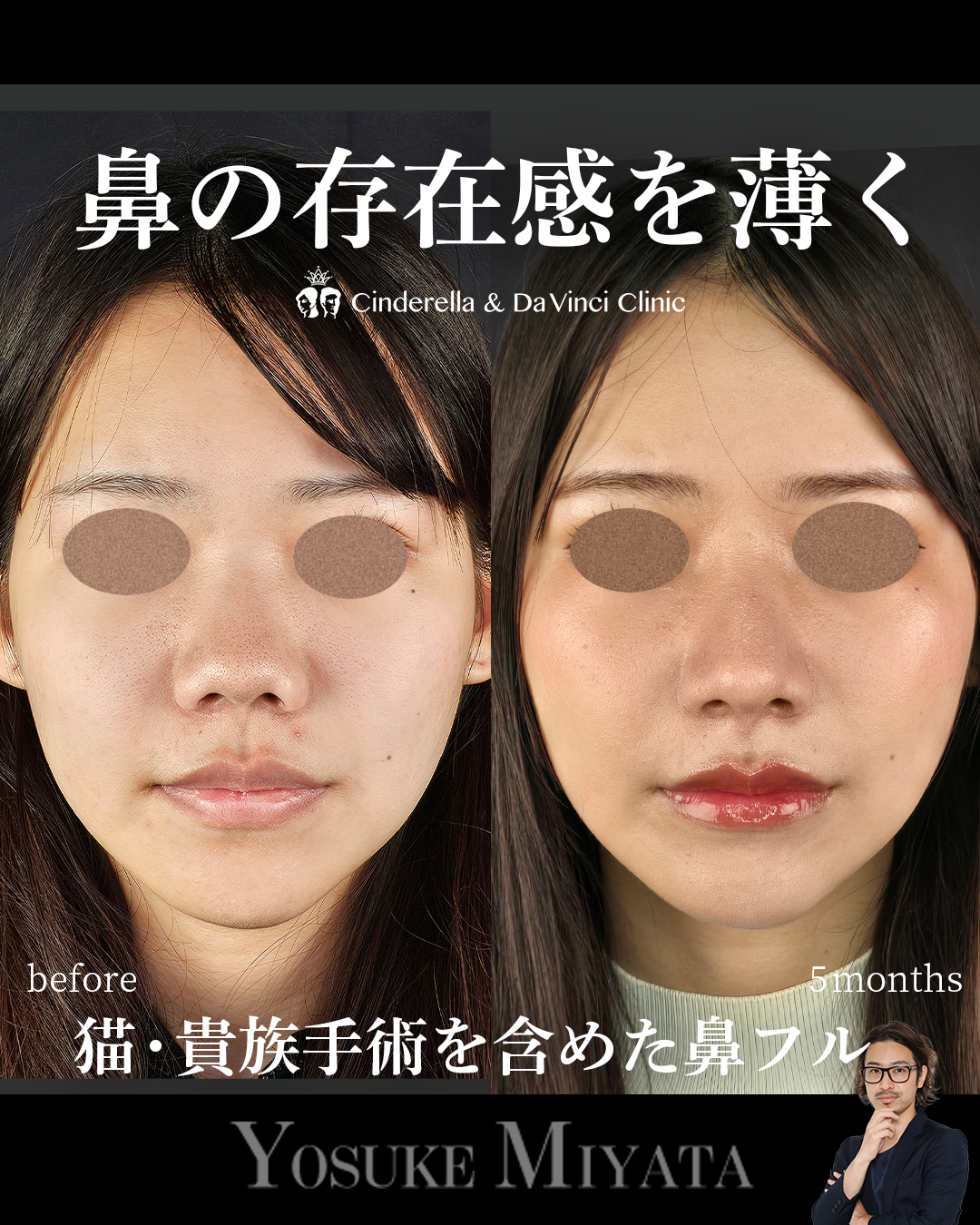鼻の存在感を薄くの画像