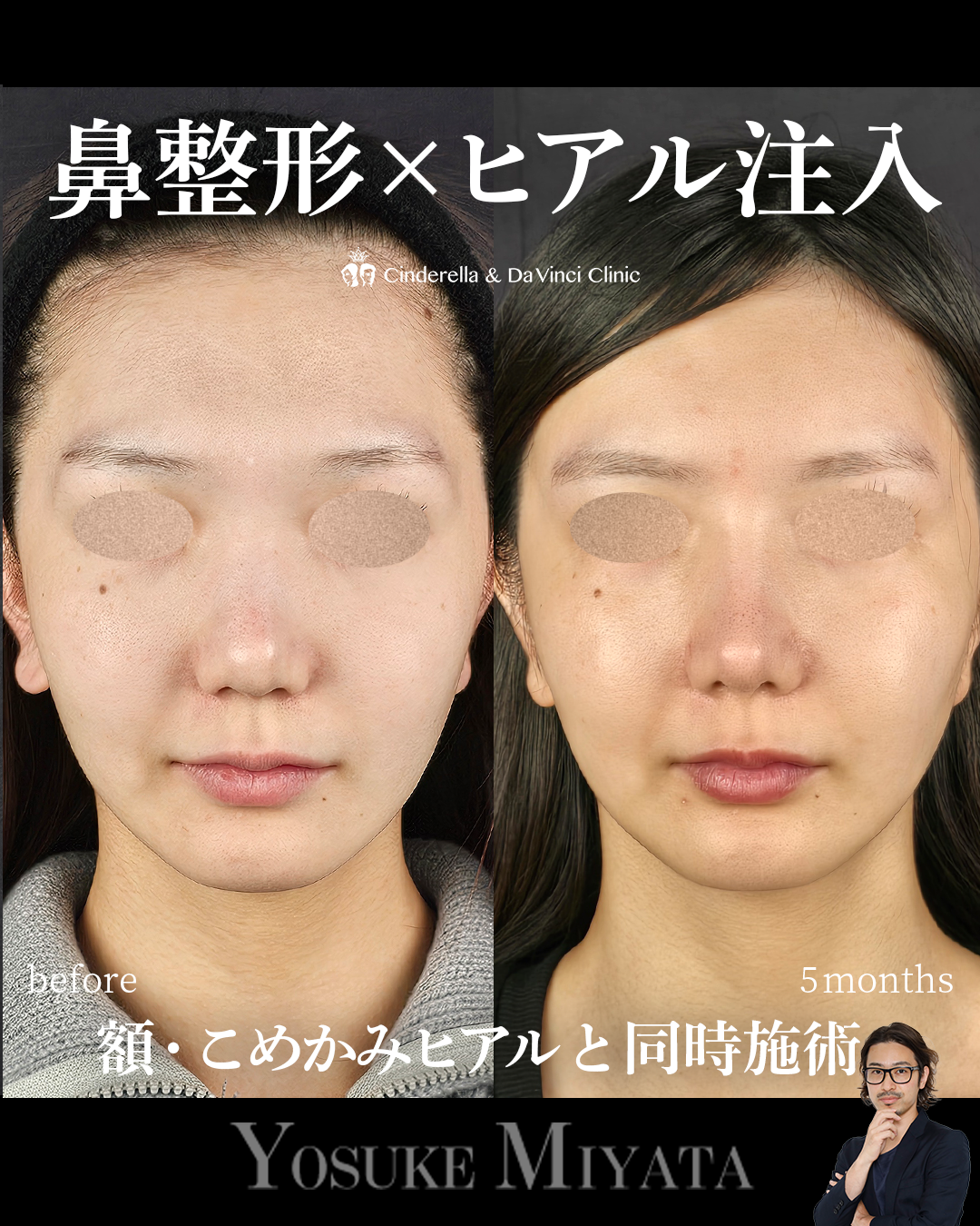 鼻整形×輪郭の画像