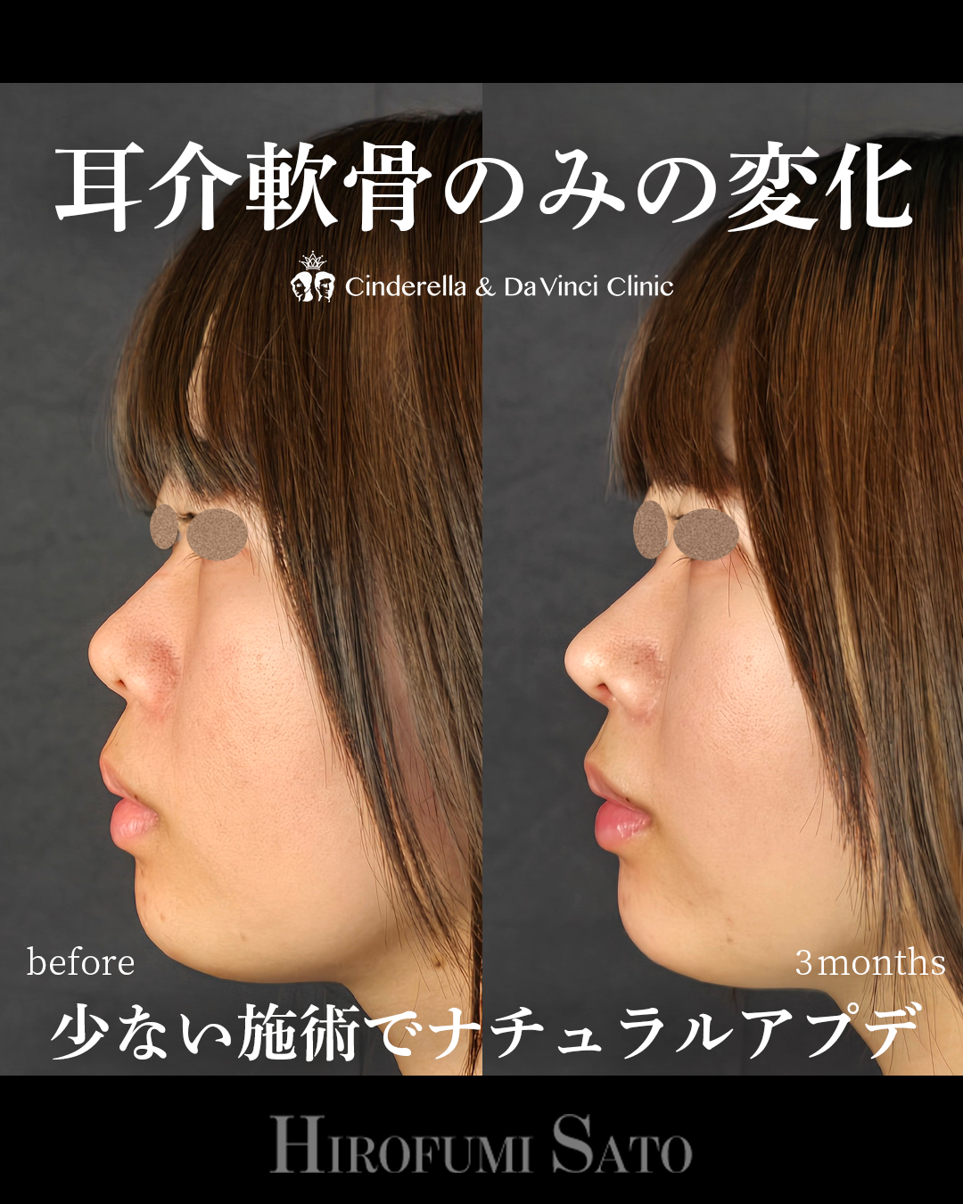 少ない施術でナチュラルアプデの画像