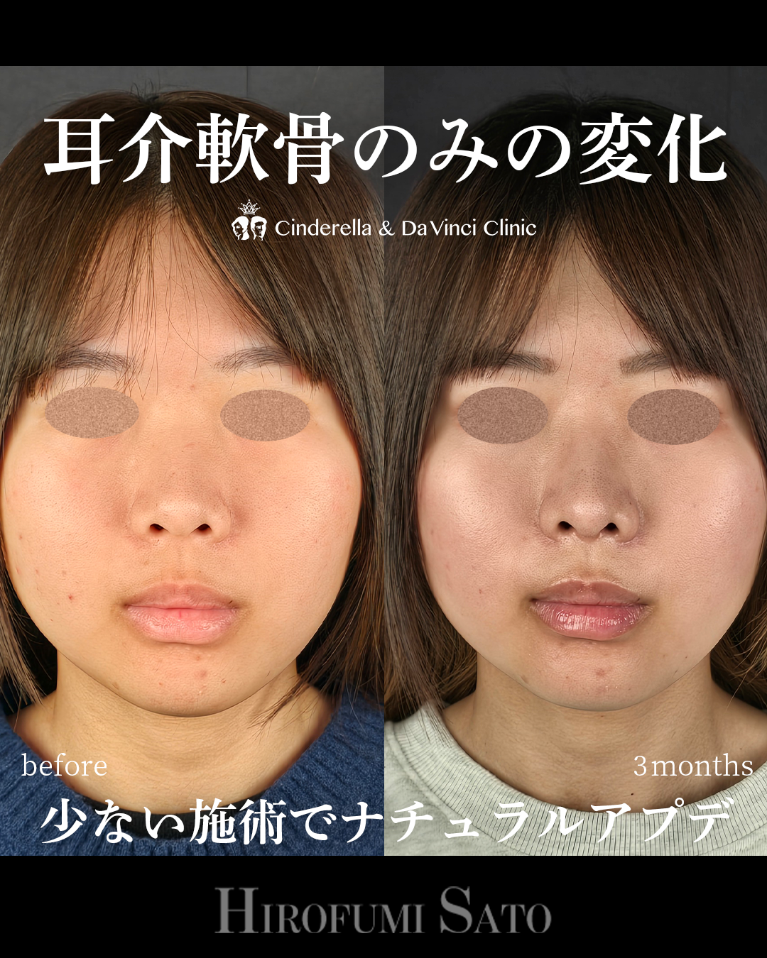 少ない施術でナチュラルアプデの画像