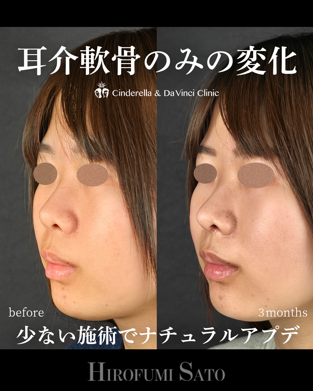少ない施術でナチュラルアプデの画像