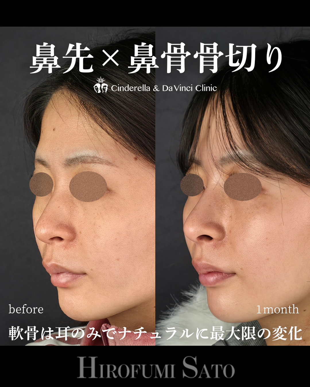 ナチュラルな鼻整形の画像