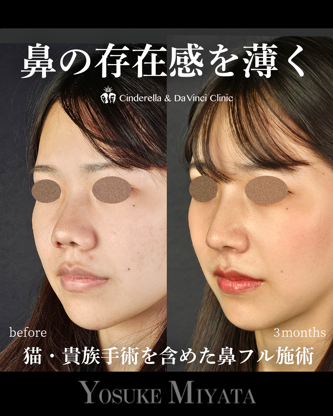 鼻の存在感を薄くの画像