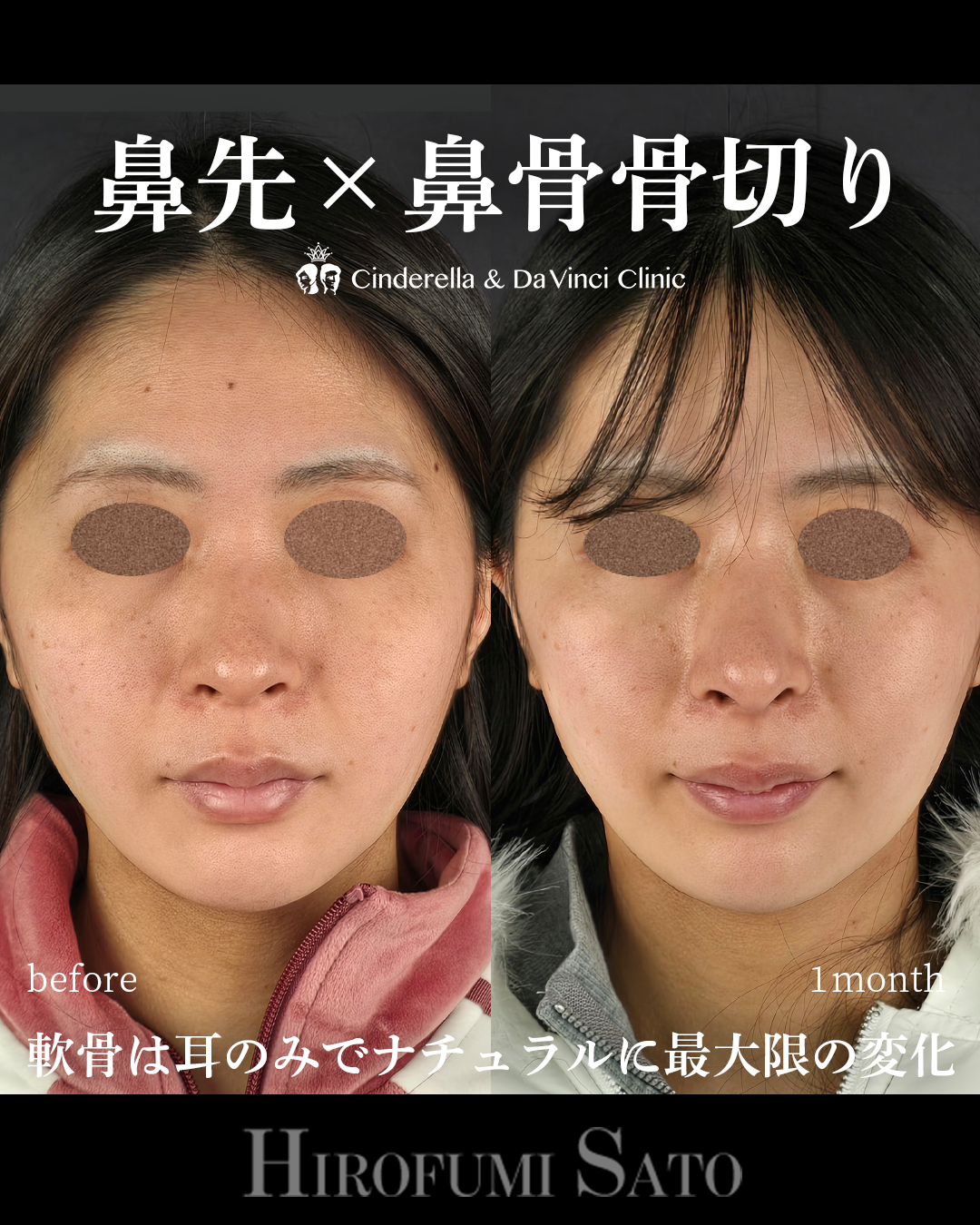 ナチュラルな鼻整形の画像