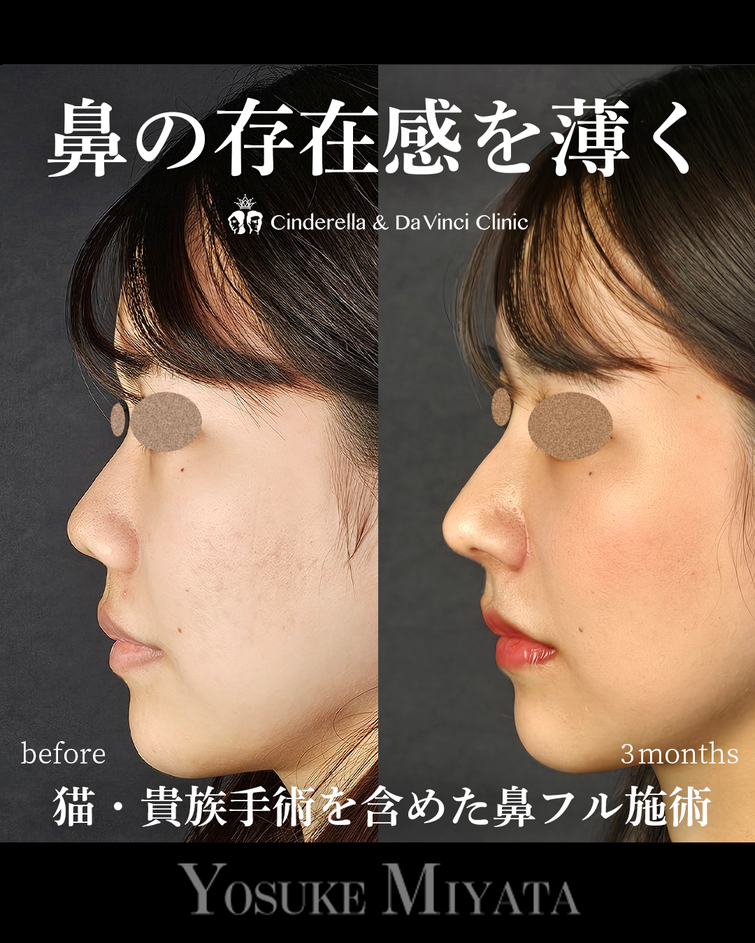 鼻の存在感を薄くの画像