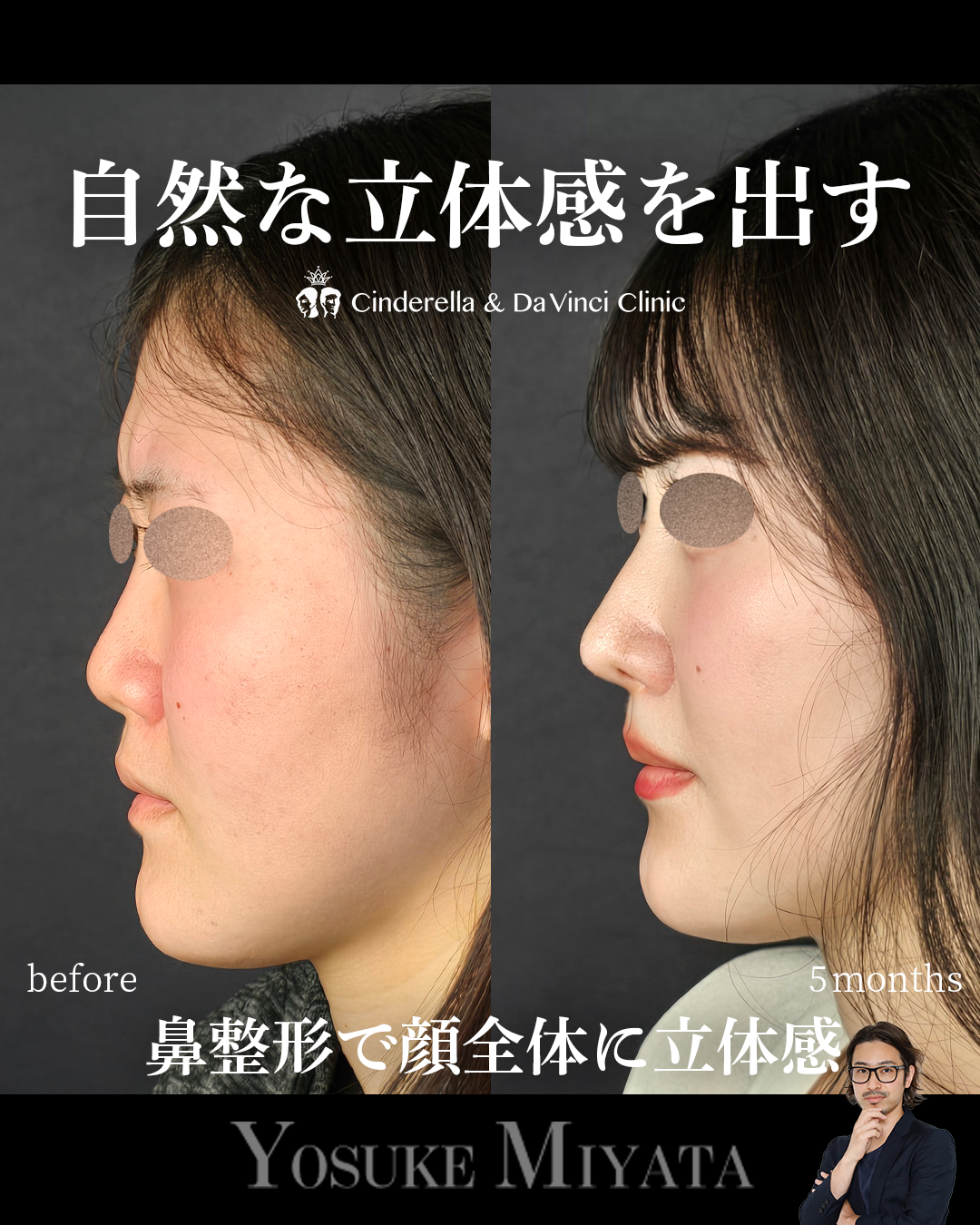 小鼻を小さく見せるの画像