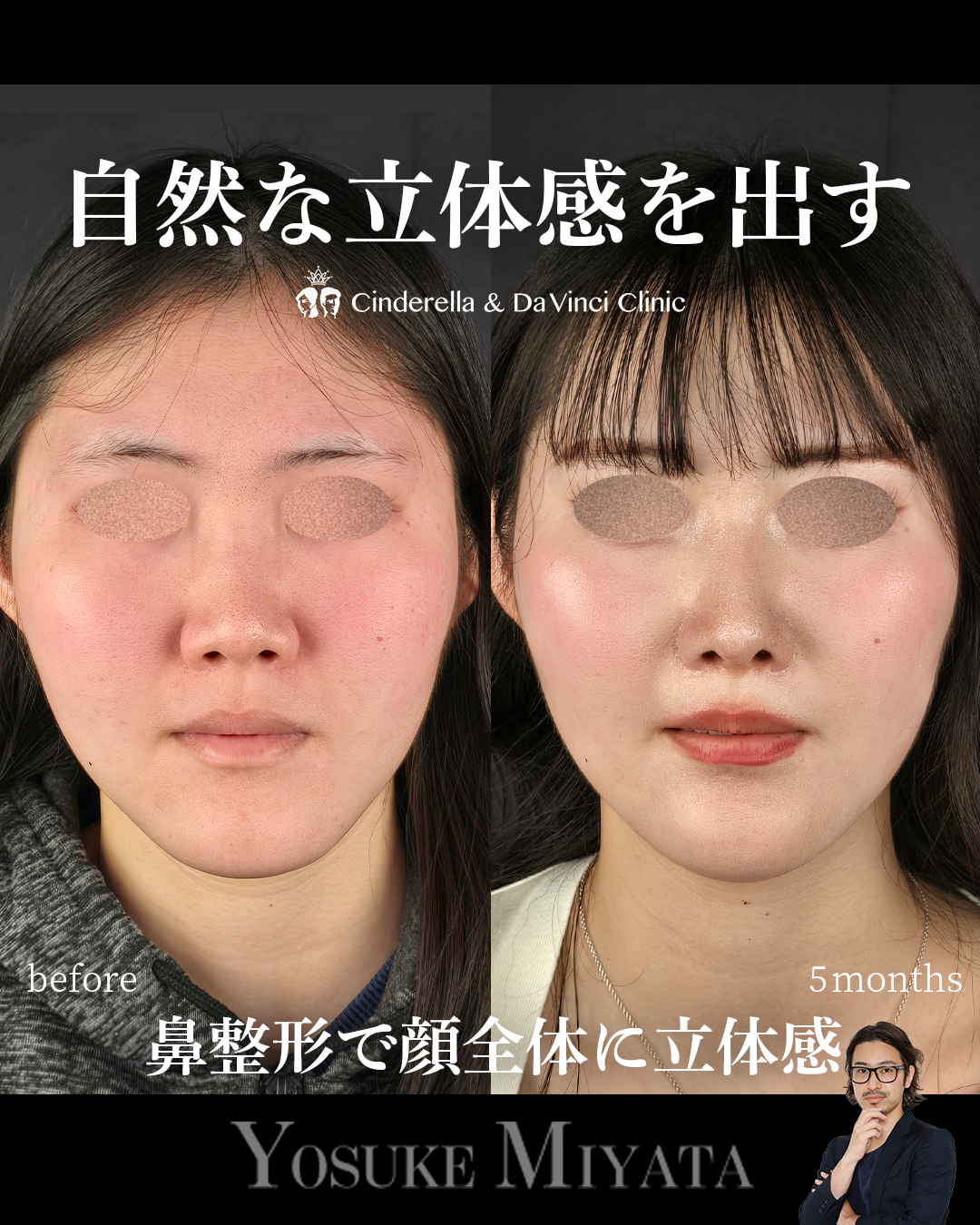 小鼻を小さく見せるの画像