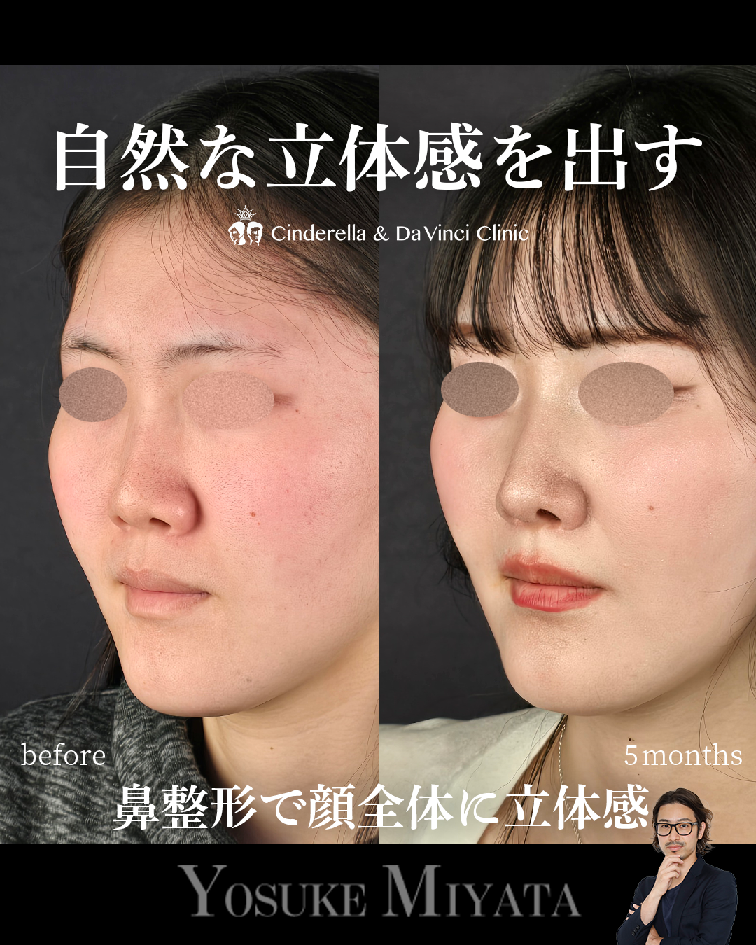 小鼻を小さく見せるの画像