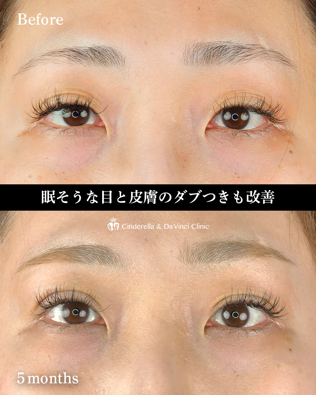 眼瞼下垂手術の画像