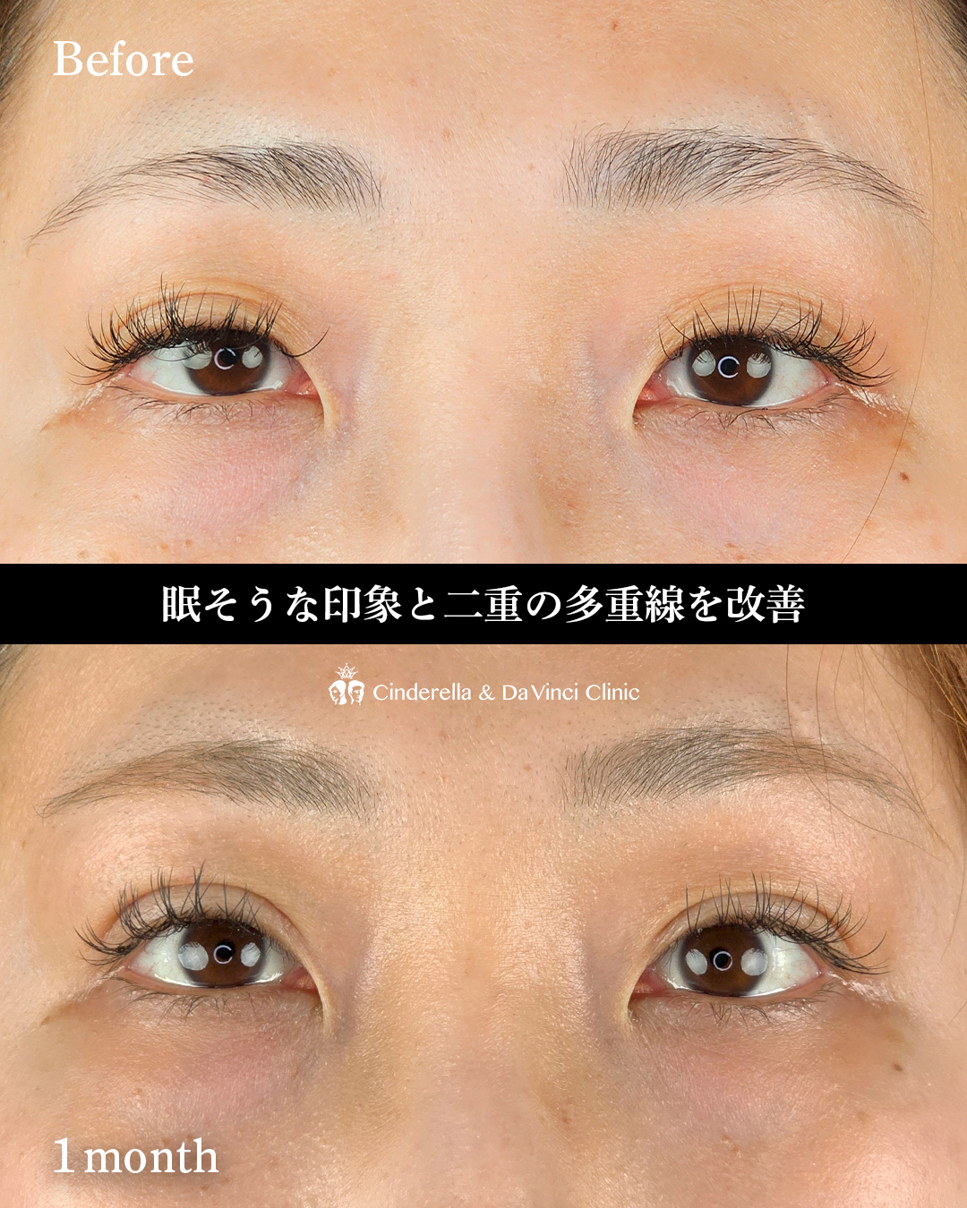 眼瞼下垂手術の画像