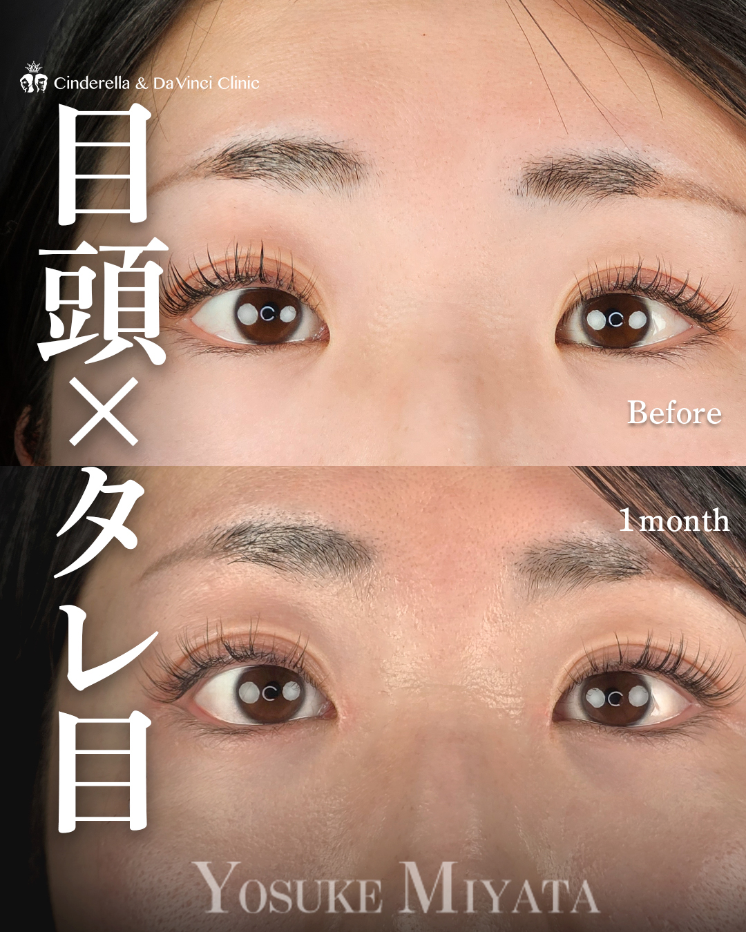 目頭切開とタレ目同時