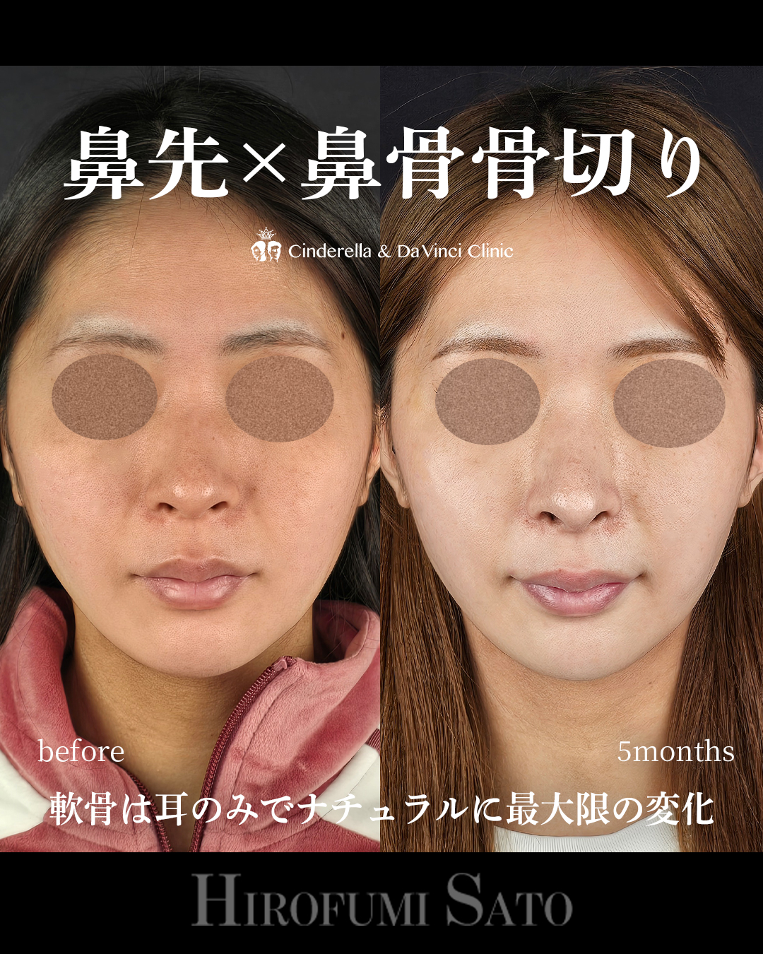 ナチュラルな鼻整形の画像