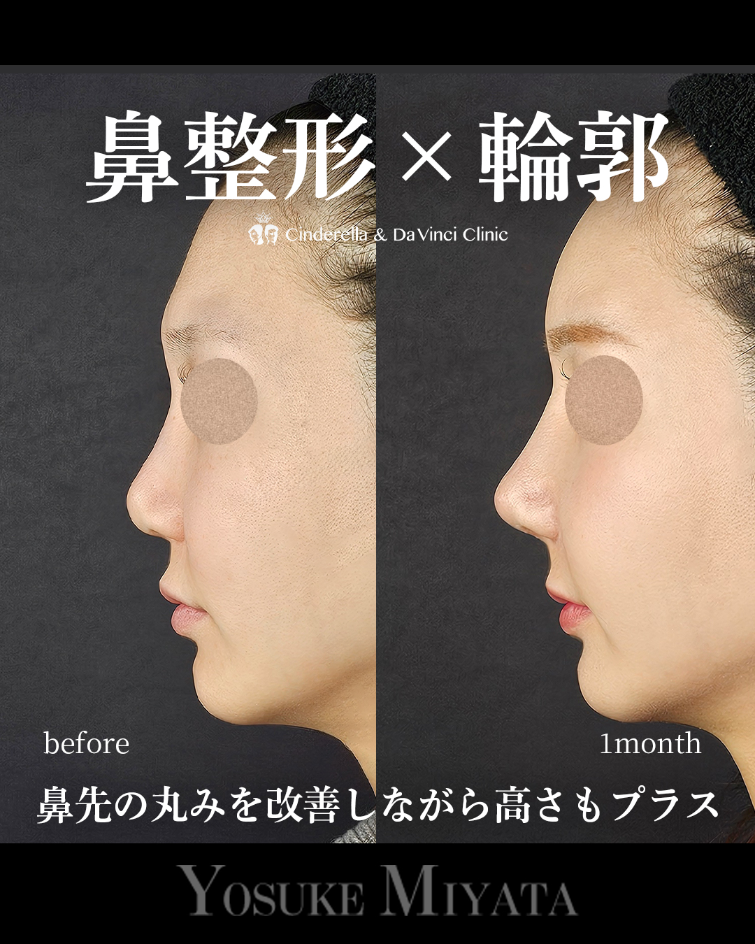 鼻整形×輪郭
