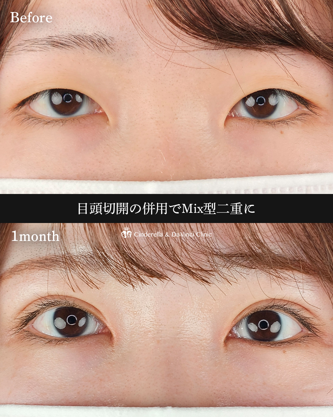 理想のMix型への画像